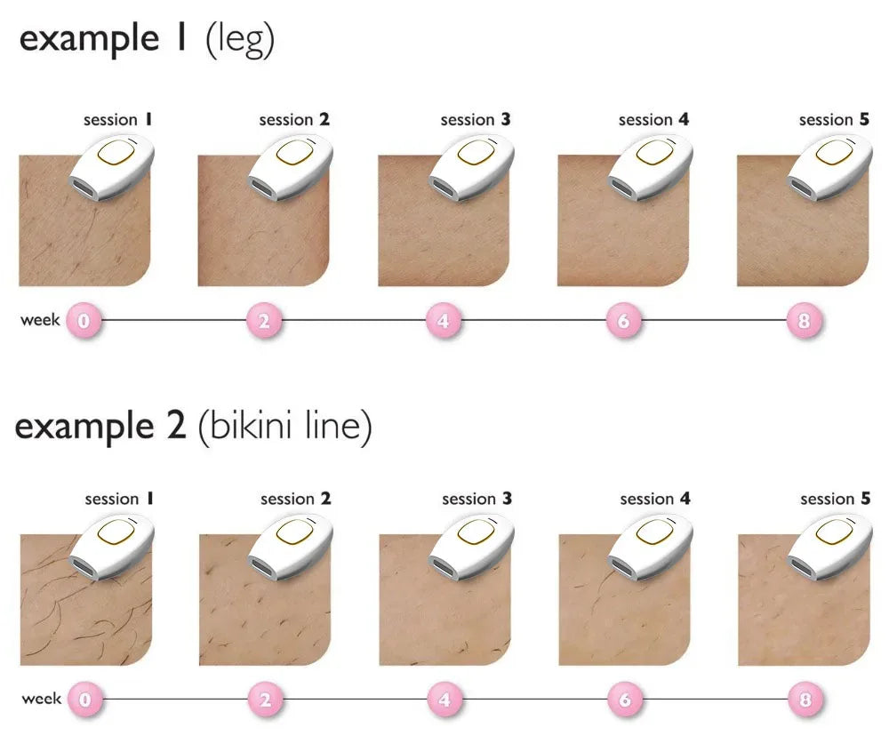 Appareil de beauté pour le rajeunissement de la peau et l'élimination des marques par photons, pour l'épilation à domicile, rasoir pour l'épilation des poils du maillot.